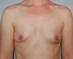 Breast Augmentation