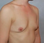 Breast Augmentation