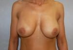 Breast Implant Revision
