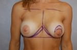 Breast Implant Revision