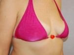 Breast Lift
