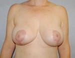 Breast Lift