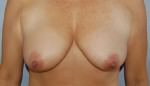 Breast Lift