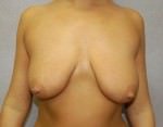 Breast Lift