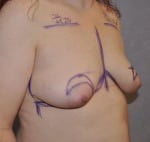 Breast Lift with Augmentation