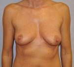Breast Lift with Augmentation