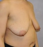 Breast Lift with Augmentation