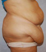 Tummy Tuck