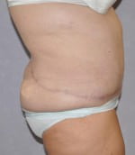 Tummy Tuck