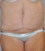 Tummy Tuck