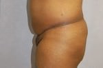 Brazilian Butt Lift Cincinnati
