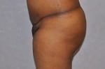 Brazilian Butt Lift Results Cincinnati