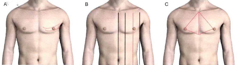 Determining nipple location for the male.