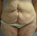 Tummy Tuck Results Cincinnati