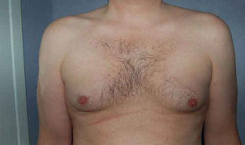 Male Breast Reduction Results Cincinnati