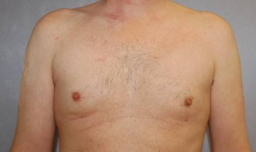 Male Breast Reduction Results Cincinnati
