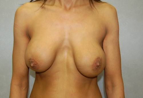 Breast Surgery Revision Results Cincinnati