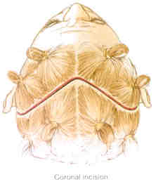 browlift2 Coronal Incision