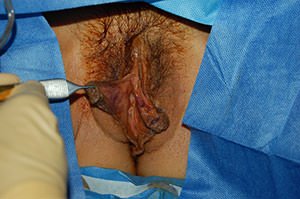 Labiaplasty Results Cincinnati