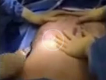 Operating Room Video: Body Contouring - J-plasma