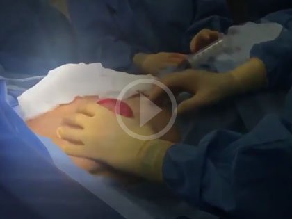Operating Room Video: Breast Augmentation and Lift