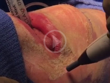Operating Room Video: Dr. Mandell-Brown Demonstrates J-Plasma!