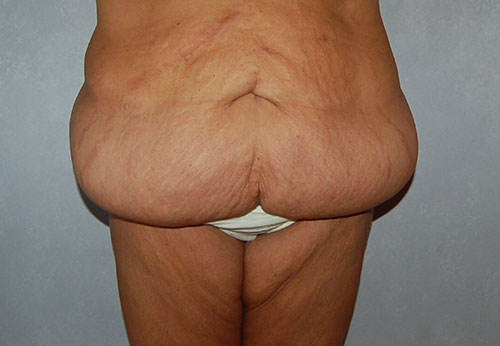 Thigh Lift Case Study