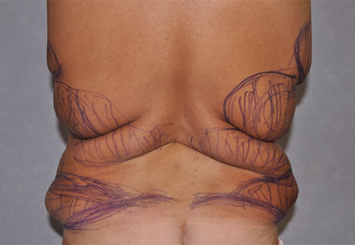 Thigh Lift Case Study