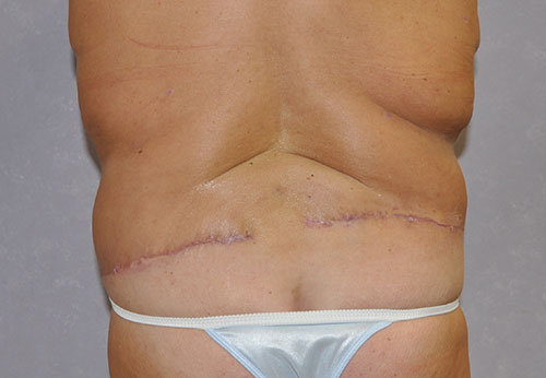 Thigh Lift Case Study