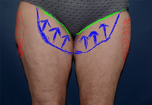 Thigh Lift Case Study