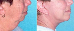 when is the best age for facelift surgery, photo of facelift cincinnati