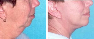 when is the best age for facelift surgery, photo of facelift cincinnati