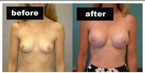 cincinatti_breast_implants