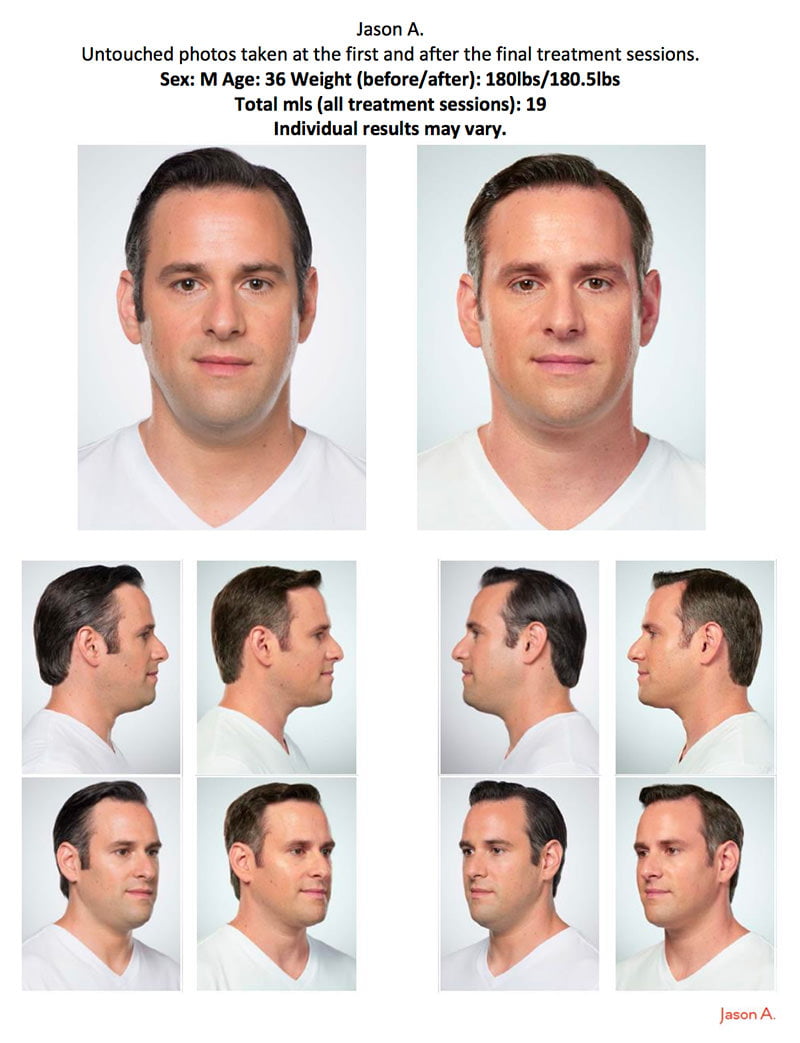 Man before and after Kybella double chin treatment