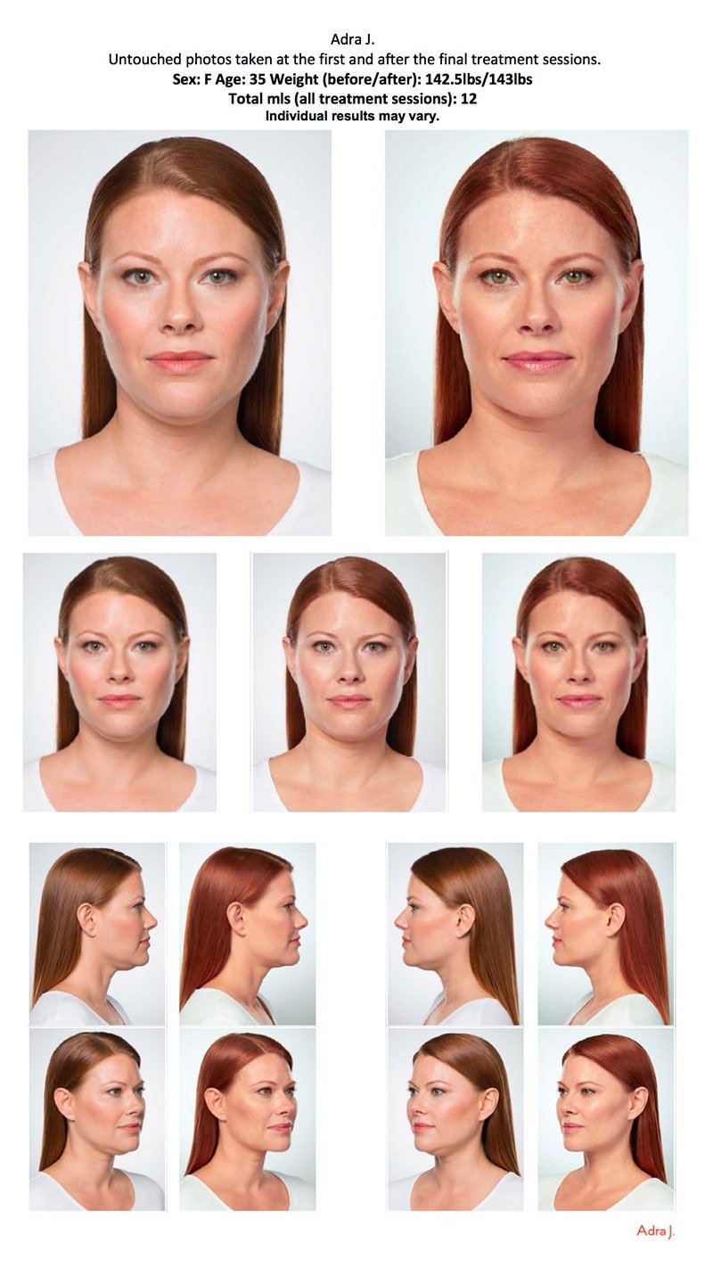 woman before and after kybella injections