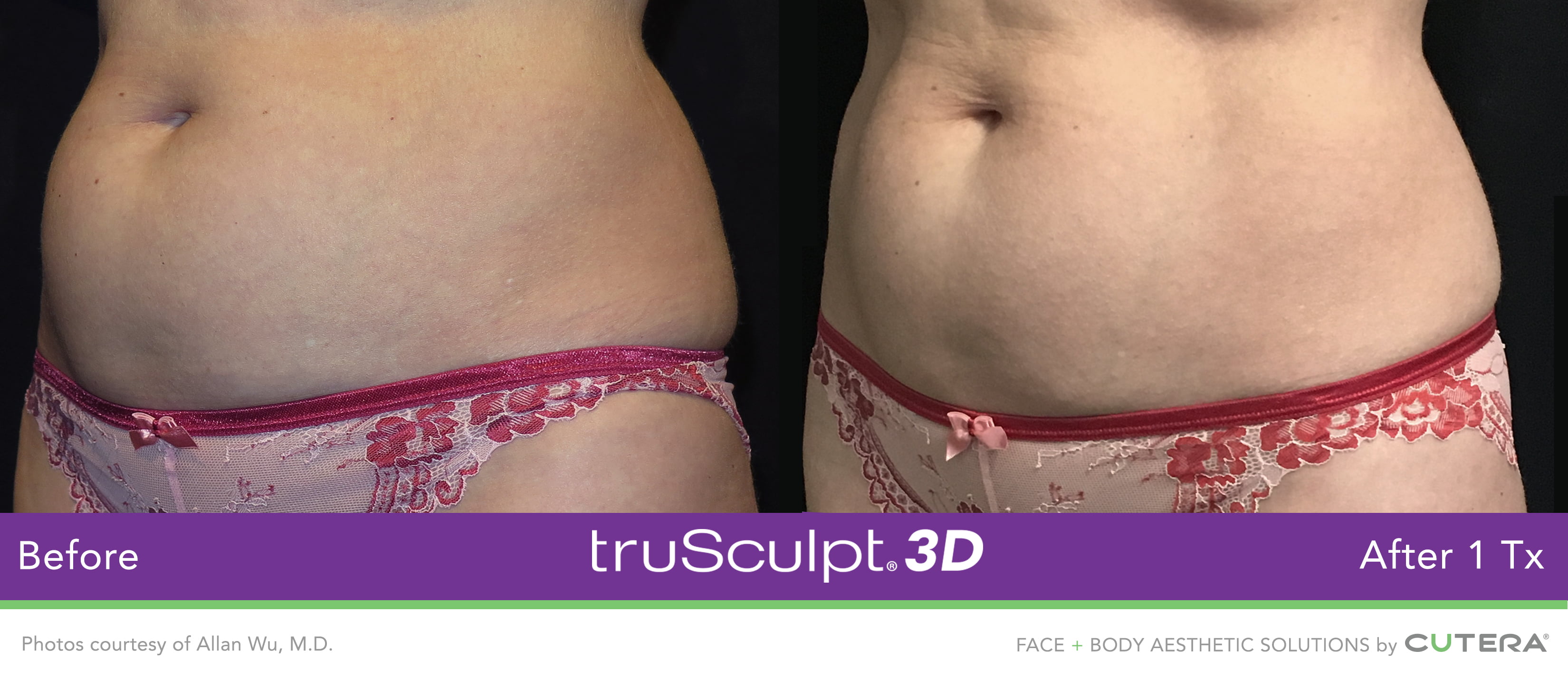 Before and after truSculpt 3D