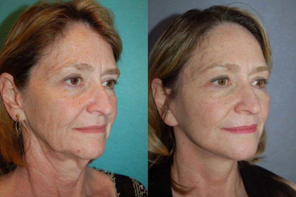 Before and after facelift surgery with Dr. Mandell-Brown