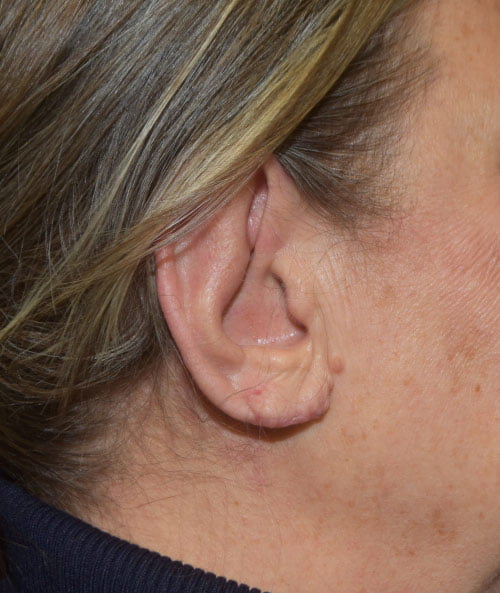 Earlobe Reduction with Otoplasty