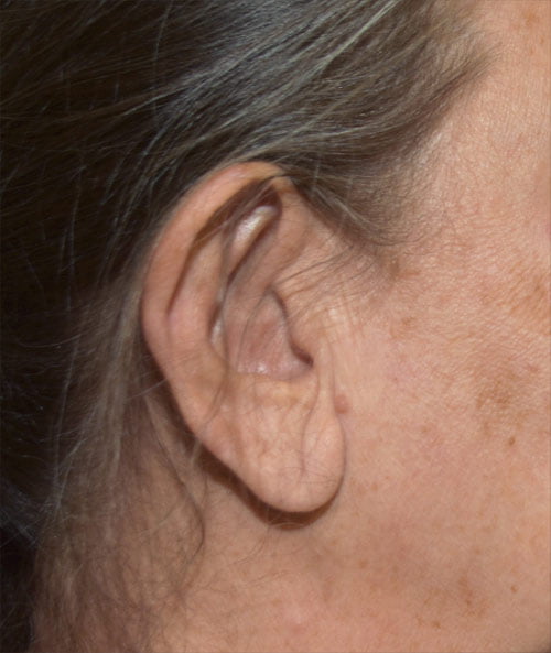 Earlobe Reduction with Otoplasty