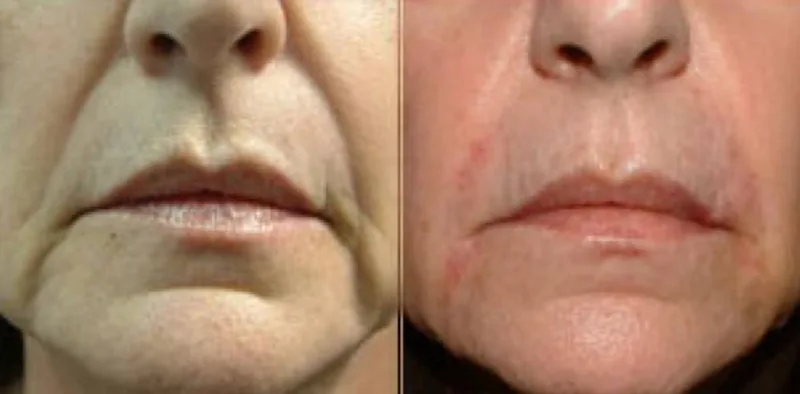 Patient of Dr. Mandell Brown shown before and after non-surgical facial rejuvenation with Restylane fillers