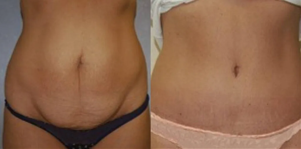 Before and after tummy tuck with Cincinnati cosmetic surgeon Dr. Mandell-Brown