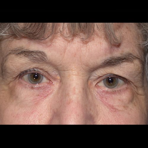 xanthelasma removal