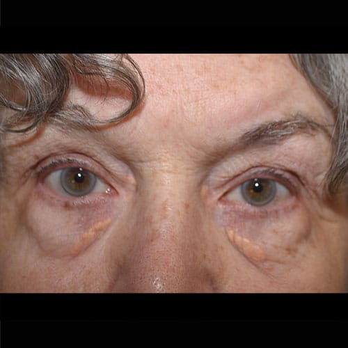 xanthelasma removal