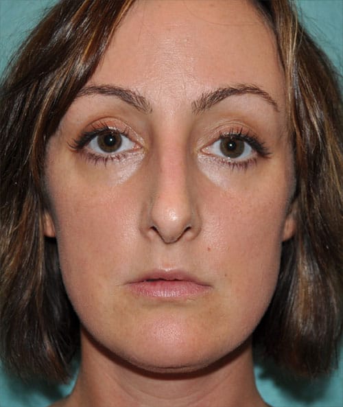 Rhinoplasty