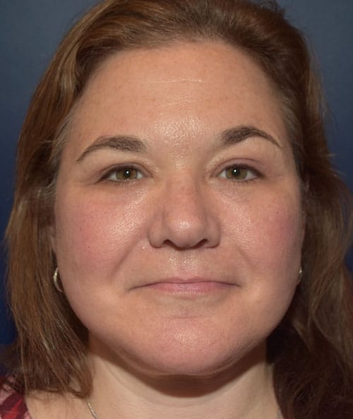 Deep Plane Facelift, Eyelids, & Earlobe Repair
