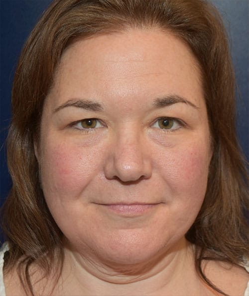 Deep Plane Facelift, Eyelids, & Earlobe Repair