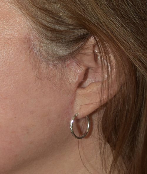Earlobe Repair