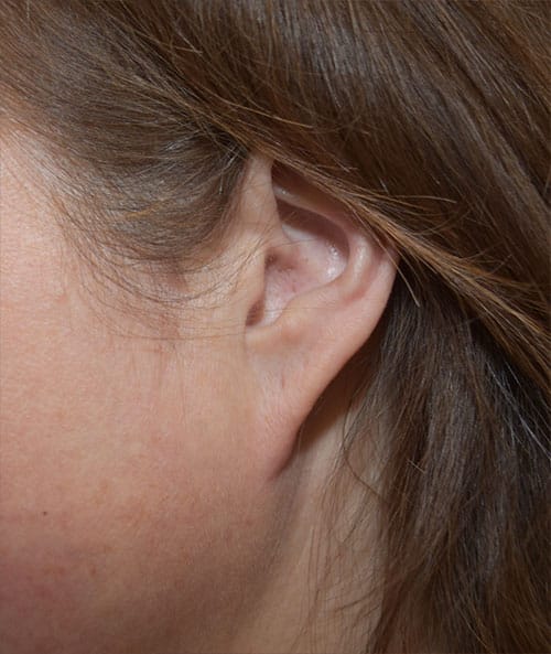 Earlobe Repair