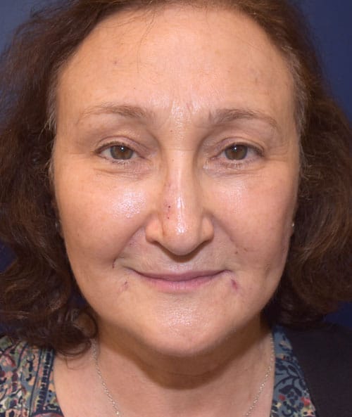 Eyelid Surgery