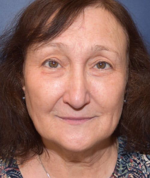 Eyelid Surgery